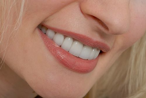Răng sứ titan có mấy loại? Loại nào tốt? 3