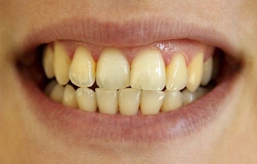 Cách tẩy trắng răng bị ố vàng tại nhà - Top 5 cách điều trị 1