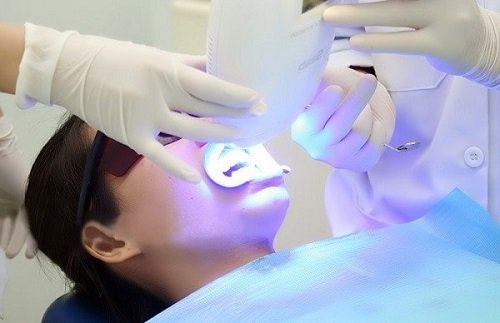 Cách tẩy trắng răng bị ố vàng tại nhà - Top 5 cách điều trị 4