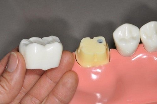 Bọc răng hàm bị sâu giá bao nhiêu vậy bác sĩ? 1