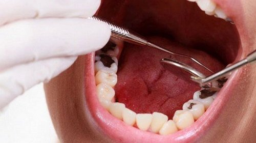 Bọc răng hàm bị sâu giá bao nhiêu vậy bác sĩ? 2