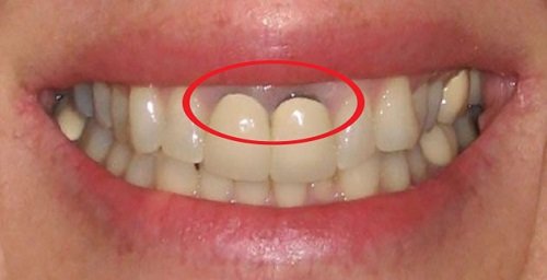 Răng sứ bị đen viền nướu có ảnh hưởng gì không? 1