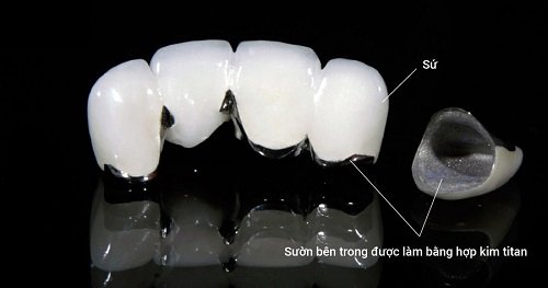 Răng sứ bị đen viền nướu có ảnh hưởng gì không? 2