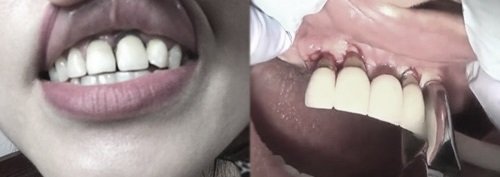 Răng sứ bị đen viền nướu có ảnh hưởng gì không? 3