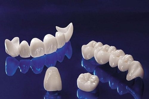 Răng sứ bị đen viền nướu có ảnh hưởng gì không? 4