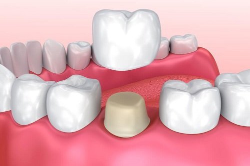 Răng sứ bị ê buốt - Top cách khắc phục hiệu quả 4