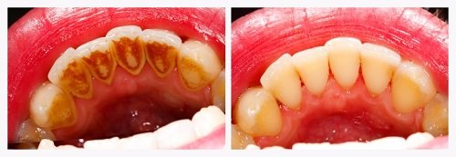 Lấy cao răng có ảnh hưởng không? Tìm hiểu về cao răng 1