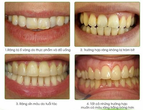 Tẩy trắng răng xong có được đánh răng không? Nha khoa giải đáp 2