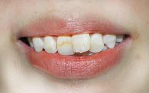 Bọc răng sứ cho răng cửa mọc lệch - Tham khảo 1