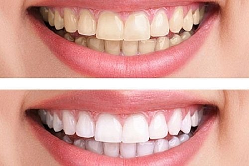 Bột tẩy trắng răng eucryl có tốt không? Chia sẻ từ chuyên gia 3