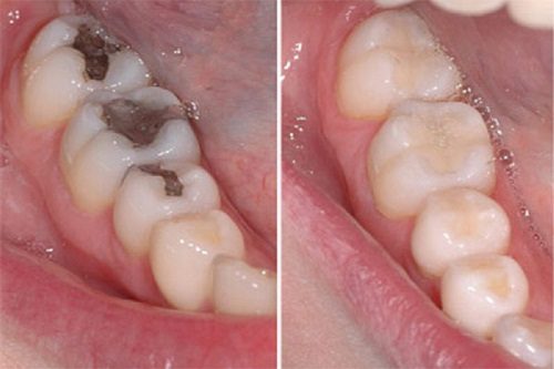 Làm răng sứ có đau không? Kinh nghiệm làm răng sứ 1
