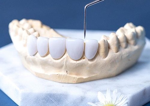 Răng sứ ceramill và những điều cần biết 1