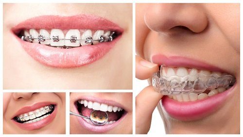 Niềng răng chỉnh hàm lệch - Giải pháp hiệu quả 1
