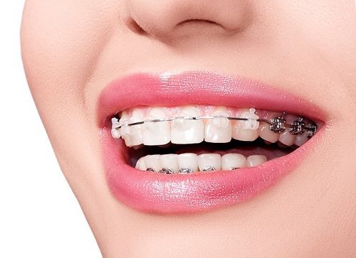 Niềng răng chỉnh hàm lệch - Giải pháp hiệu quả 2