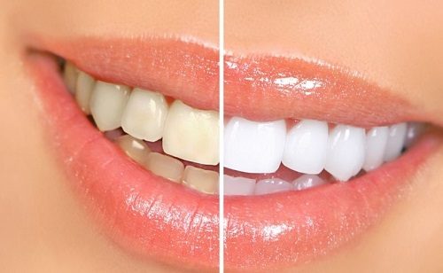 Tẩy trắng răng hút thuốc có sao không? Cảnh báo các biến chứng có thể gặp 1
