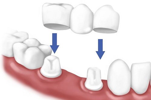 Làm răng sứ mất bao lâu là có hàm răng đẹp? 2