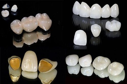 Làm răng sứ mất bao lâu là có hàm răng đẹp? 3