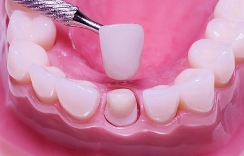 Làm răng sứ có niềng răng được không bác sĩ? 1