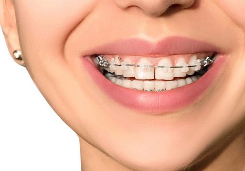 Làm răng sứ có niềng răng được không bác sĩ? 2