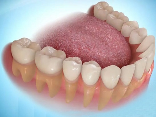 Trồng răng giả có lâu không? Các bước thực hiện 1